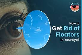 Image result for Floaters
