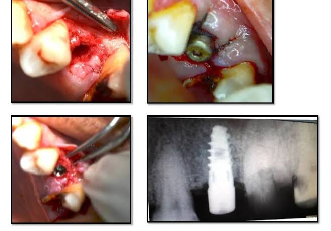 Dental implant surgery