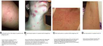 Presentation And Natural History Of Progestogen Hypersensitivity Annals Of Allergy Asthma Immunology