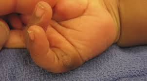 Image result for Supernumerary Digit