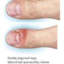 Image result for Koilonychia feet