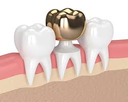 Gold has been used in dentistry for tooth repair for more than 4,000 years. How To Care And Maintain Gold Dental Crowns