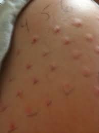 Pin On Allergy Relief