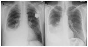 Loss of the costophrenic angle. Evaluation Of The Patient With Pleural Effusion Cmaj