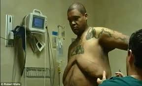Before gastric bypass surgery updated september 6, 2020. Man Who Lost 750lbs After Gastric Bypass Wants To Inspire Others Daily Mail Online