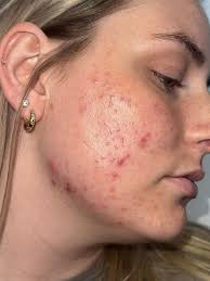 Just a little reminder that yes—even your esthetician experiences  breakouts! 🙋‍♀️✨ It's not always easy to feel comfortable in your skin  when acne shows up, but you're not alone. With the right