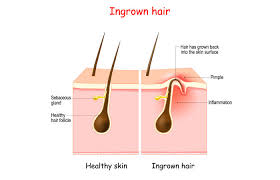 For my education as well as yours! Ingrown Hair Scars How To Prevent And Heal Them Paloy