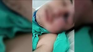 Maybe you would like to learn more about one of these? Hongo Negro En Mexico Gregorio El Presunto Infectado Perdio Un Ojo Parte De La Nariz Y Del Paladar Infobae