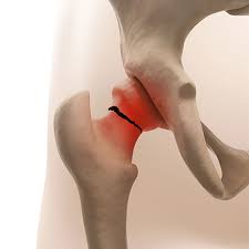 Groin injuries are particularly common in activities in which forceful. Groin Pain Groin Muscle Pain Groin Physiotherapist In Petoria
