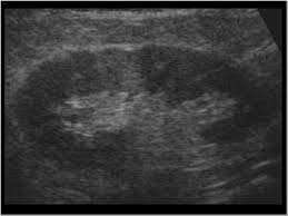 Once renal parenchymal disease develops, kidneys lose its ability to remove the waste products from the blood, causing various symptoms. Urinary Tract And Male Reproductive System 2 1 Kidney And Ureter Case 2 1 14 Renal Vascular Disease Ultrasound Cases