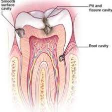 Foods To Be Avoided After A Tooth Filling Home Health Remedies Home Remedies For Cavities Home Health