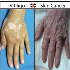 skin cancers can look very different and the symptoms can vary. I Have Vitiligo Will I Get Skin Cancer Vitiligo Clinic Research Center
