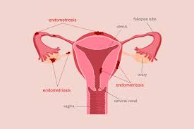 Pathogenetic implications of the anatomic distribution. Conditions Endometriosis Is Mistaken For The Most Reader S Digest