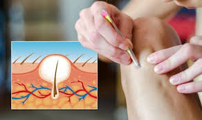 In women, the most common. Ingrown Hair Removal How To Get Rid Of Ingrown Hairs Expert Recommends Treatment Express Co Uk