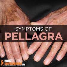 Pellagra: Symptoms, Causes & Treatment |