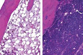 It affects plasma cells in the bone marrow. Prostate Cancer Drug Could Protect Bone Marrow From Damage Caused By Radiation Memorial Sloan Kettering Cancer Center
