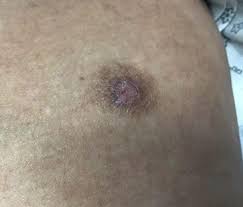 Image result for Tick Bite