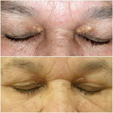 Image result for xantelasma