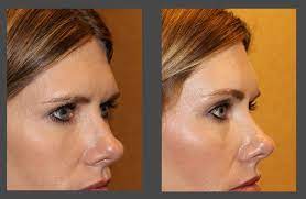 Excess skin and fat are removed. Forehead And Eyebrow Lift In Iran Irantreatments