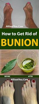 Get Rid Of Bunions Naturally With This Simple But Powerful Remedy Health Fitness Beauty Bunion Bone Get Rid Of Bunions Bunion Remedies Bunion Treatment