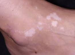 Maybe you would like to learn more about one of these? Vitiligo Erkrankungen Der Haut Msd Manual Profi Ausgabe