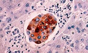 Image result for cancer