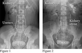 Image result for Nephrolithiasis Imaging