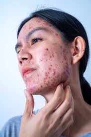 Image result for acne face