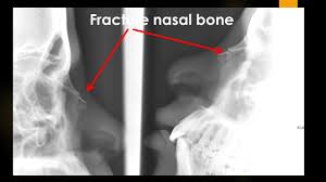 The diagnosis is usually made on the. Case 717 Fracture Nasal Bone Youtube