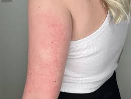 Image result for Keratosis pilaris