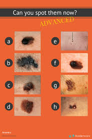 Can You Spot The Cancerous Mole Online Dermatology Cancerous Moles Skin Moles Mole