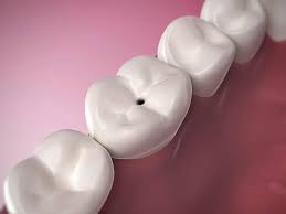 Small Black Point On My Teeth What Is It Bello Dental Associates Cosmetic Dentists