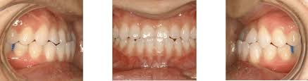 The expander is fixed on the roof of mouth at night and widened every night. Crossbites Before After Treatment