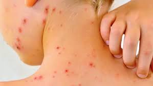 Sarampión: qué es, síntomas, cómo se contagia y posibles complicaciones -  Yahoo Noticias