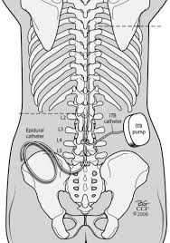 Image result for Intrathecal Pump