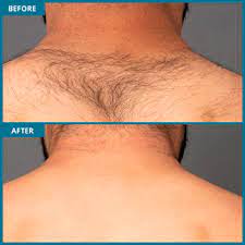 Our services include laser hair removal, skin rejuvenation, age and brown spot removal, vein reduction, chemical peels, and neova skin care products. Laser Hair Removal For Men Milan Laser In Dallas Tx