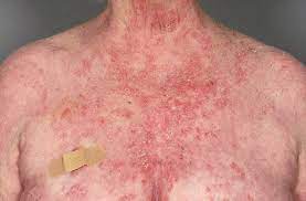 Segundo o proprietário do carro que é comerciante, ele alugou a casa há quatro meses e usa o imóvel como ponto comercial para venda de frutas. Pemphigus Foliaceus Including Fogo Selvagem Dermatology Advisor