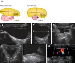 Ultrasound Of The Urogenital Tract In Neonates Infants And Children Springerlink