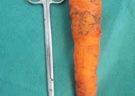 استخراج جزرة طولها 15 سم من بطن مسن بقنا دخلت من فتحة الشرج صور