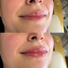 Lippies ✨💋 Don't forget to take advantage of May lip filler deals before  they're gone! #sknrgy #sknrgyaesthetics #medspatucson