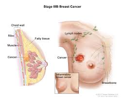Image result for Inflammatory breast cancer