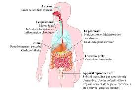 Vaincre la mucoviscidose, paris, france. Principales Atteintes De La Mucoviscidose Modifiee D Apres 19 154 Download Scientific Diagram