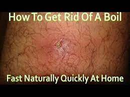 You are more likely to get. Armpit Boil Symptoms Causes Images Painful Staph Infection With No Head Deep Ingrown Hair Cyst Removal Ingrown Hair Cyst Staph Infection Ingrown Hair