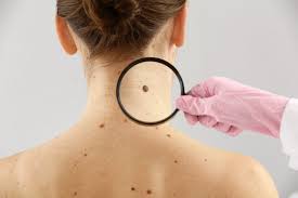 El melanoma: Un gran peligro que viene de la mano del verano ...