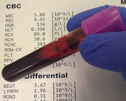 Image of Complete Blood Count (CBC) test