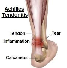 The pain commonly occurs at the undersurface of the foot called the plantar surface or at the back surface of the heel. Heel Pain Causes Symptoms Treatment Foot Pain Explored