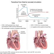 Image result for Delayed Transition from Fetal Circulation