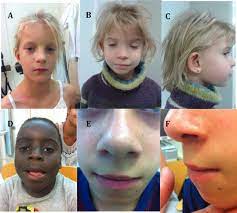 A Review Of The Physical Features Of The Fetal Alcohol Spectrum Disorders Sciencedirect