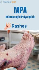 Image result for Microscopic Polyangiitis