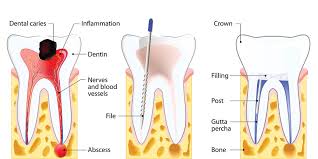 Lumpuh sakit emosi, penyakit saraf, rawatan saraf. Apa Itu Perawatan Saluran Akar Psa